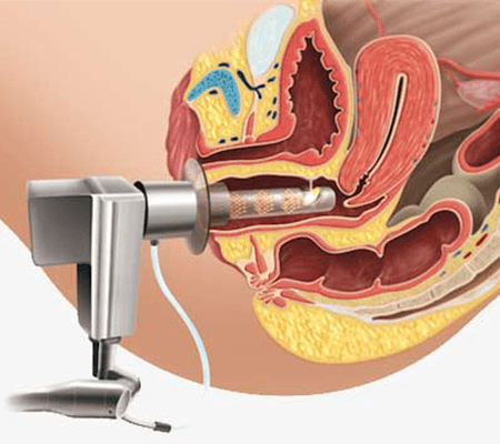 LASER TREATMENT FOR RECURRENT